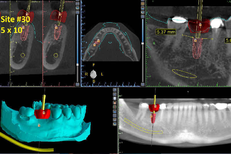 Implant Dentist in Fontana