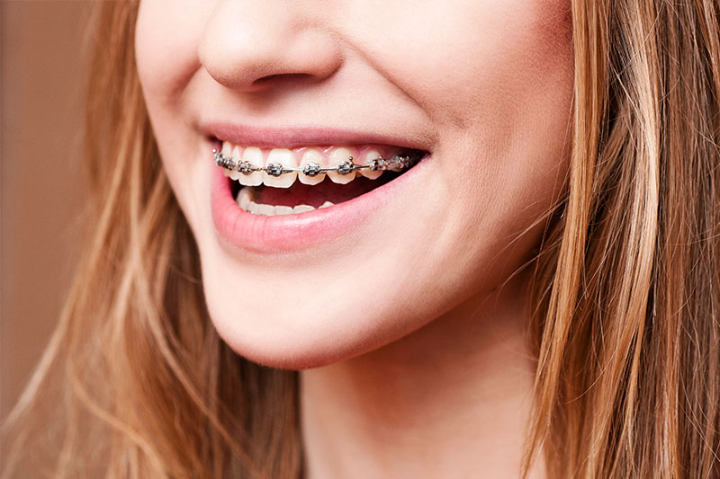 Orthodontics in Fontana